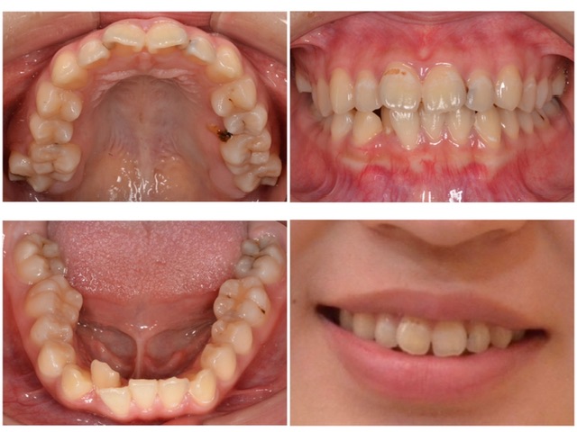 歯並びを治したい　20代女性　2024.9.12