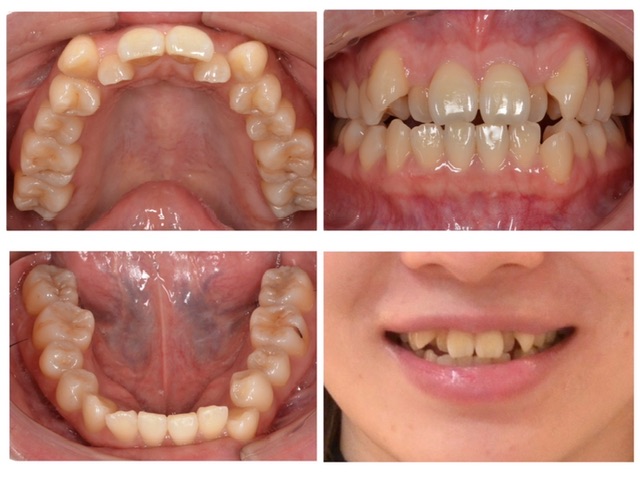 歯並びが気になる2024.10.11
