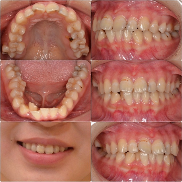 歯並びが気になる2024.11.1